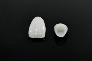 Blanqueamiento dental con implantes