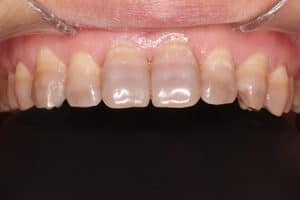 Blanqueamiento dental para manchas por tetraciclinas