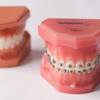 Tratamiento de ortodoncia con brackets autoligados