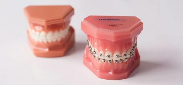 Tratamiento de ortodoncia con brackets autoligados