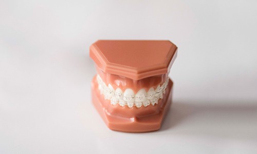 Precio de tratamiento de ortodoncia con brackets transparentes
