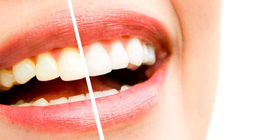 Es posible blanquear los dientes con agua oxigenada?