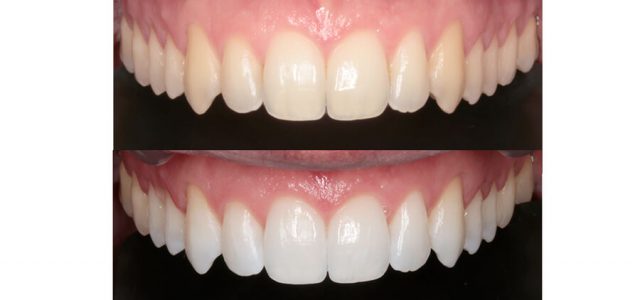 El blanqueamiento aclara varios tonos los dientes