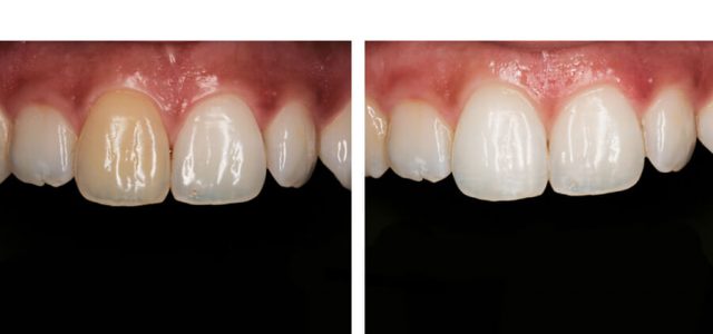 Blanqueamiento dental en diente calcificado