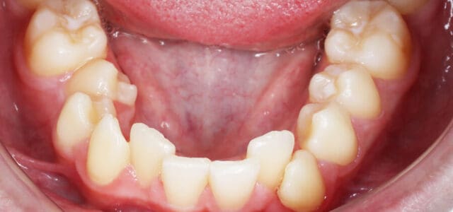 Apiñamiento dental moderad