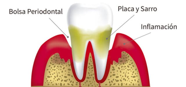 Bolsa periodontal foto