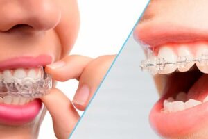 Ortodoncia con Invisalign