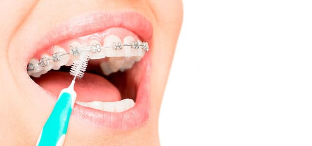 Higiene con ortodoncia fija