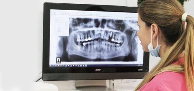 Cuidar implantes dentales