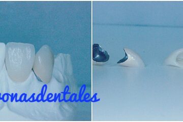 coronas dentales de zirconio precio