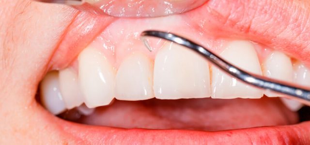Tratamiento contra periodontitis