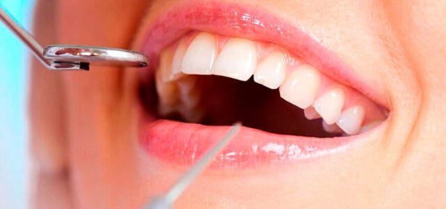 Tratamiento para dientes astillados