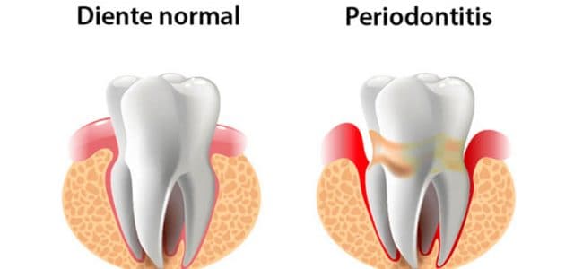 Encía con periodontitis