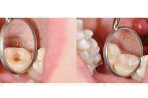 Empaste dental de composite