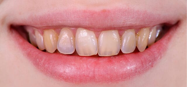Erosión en los dientes