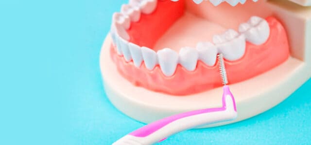 Limpiar los implantes dentales