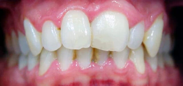 Reducir tamaño de los dientes grandes