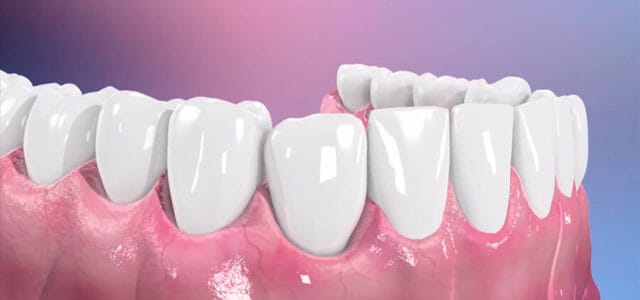Mantenimiento periodontal ambas arcadas