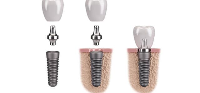 Técnicas para colocar un implante dental