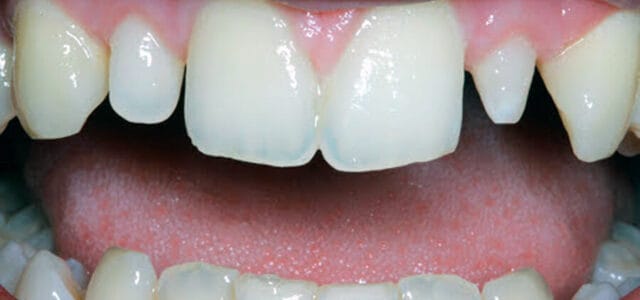 Anomalía en el tamaño del diente