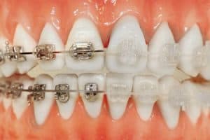 Tratamiento ortodoncia zafiro
