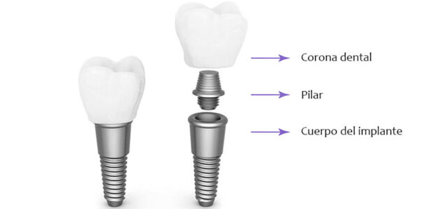 Cuerpo, pilar y corona dental