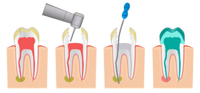 Pasos de la endodoncia
