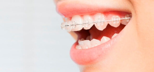 Protrusión dentaria