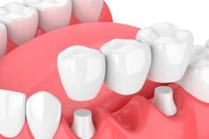 Puentes dentales sobre dientes