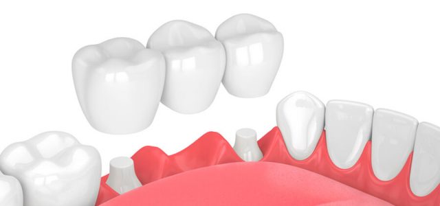 Prótesis dental fija: todos los tipos que existen | Ferrus&Bratos