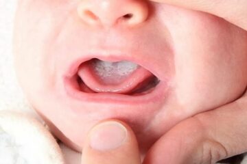 Por qué se produce la candidiasis oral