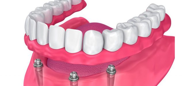 Prótesis dental semifija
