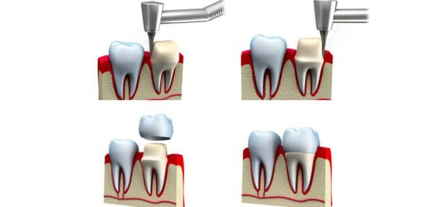 Proceso de tallado dental