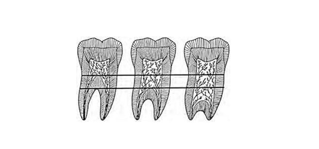 Taurodontismo dental