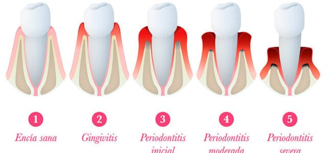 Evolución de la gingivitis