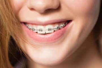 Tipos de ortodoncia para personas adultas