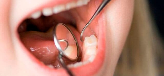 Enfermedad bucal más común