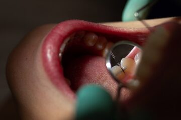 Preguntas frecuentes sobre la profilaxis dental